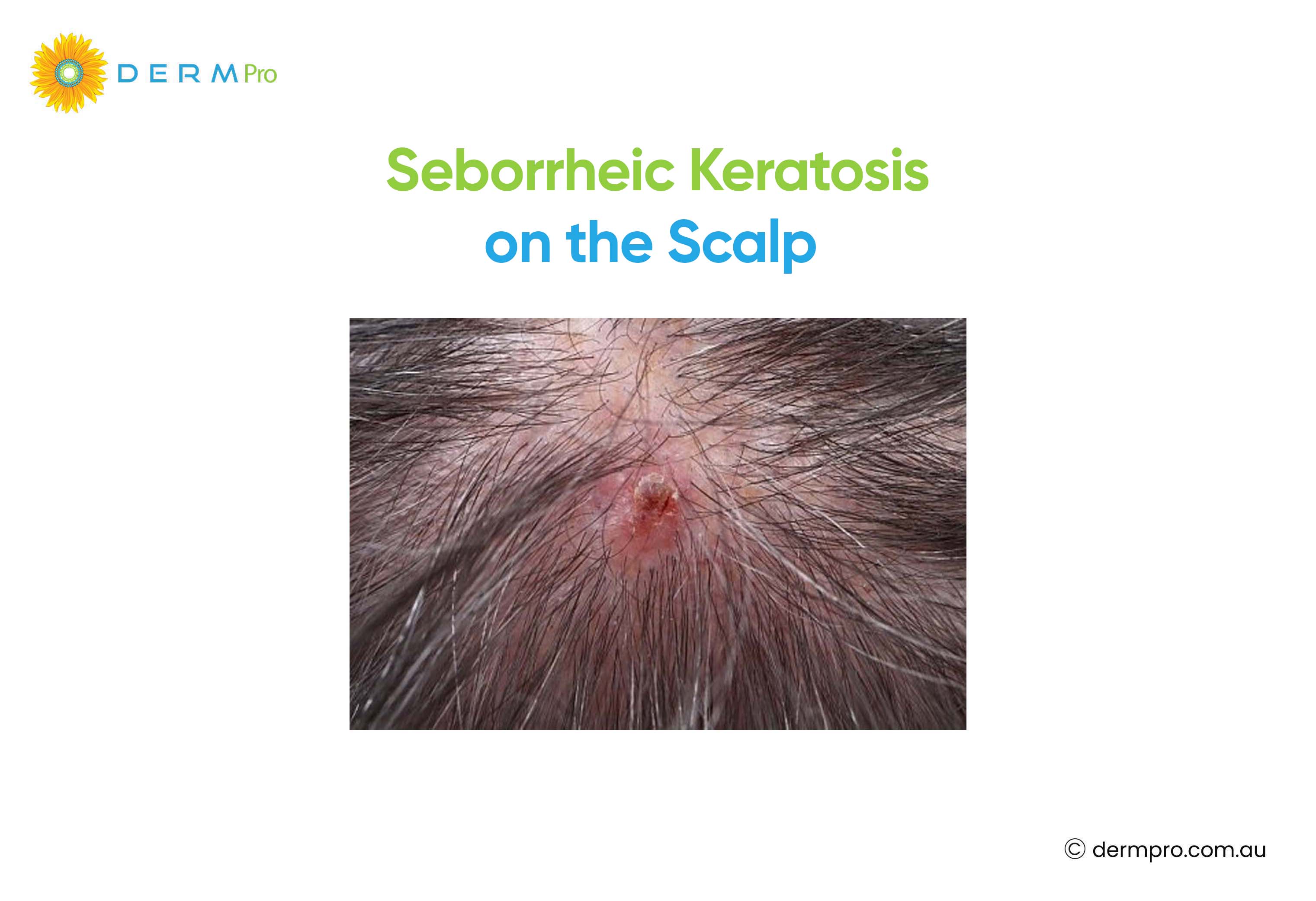 Seborrheic Keratosis on the Scalp